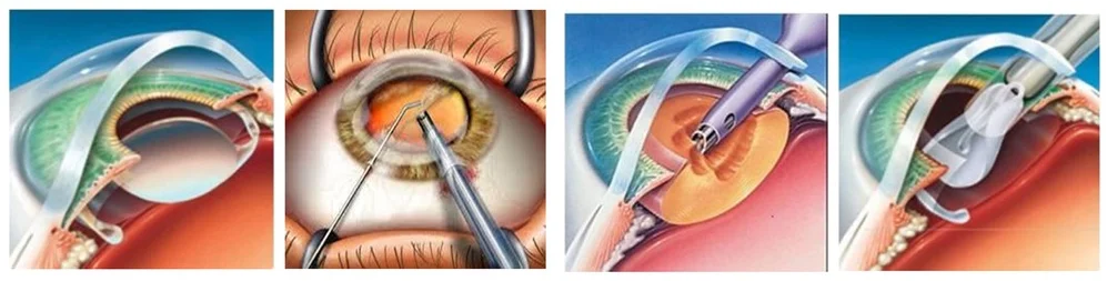 Types of cataract surgery