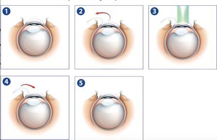 Lasik Eye Surgery