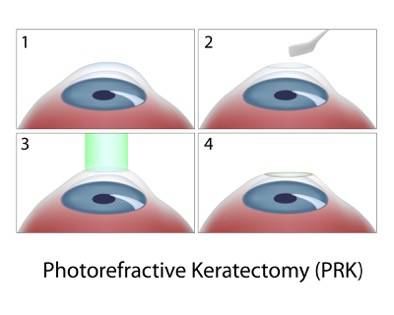 PRK Photorefractive Keratectomy