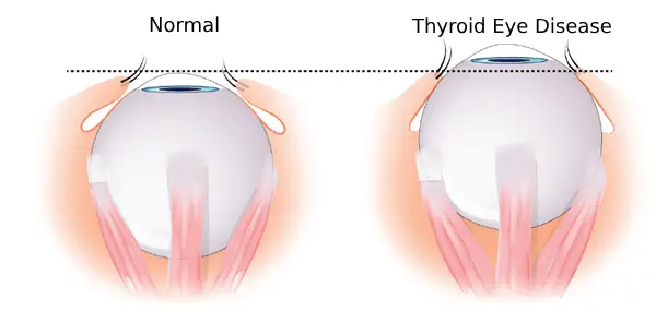 thyroid eye disease