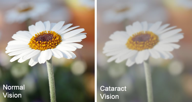 cataract surgery before and after vision