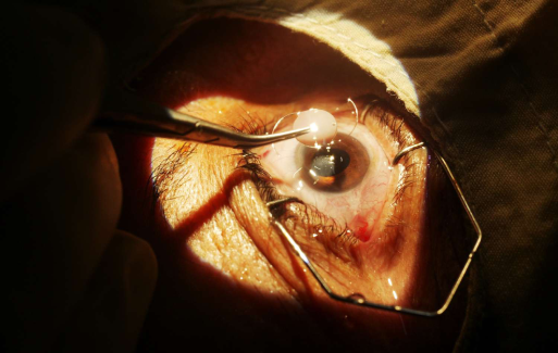 Cataract Surgery in Mumbai