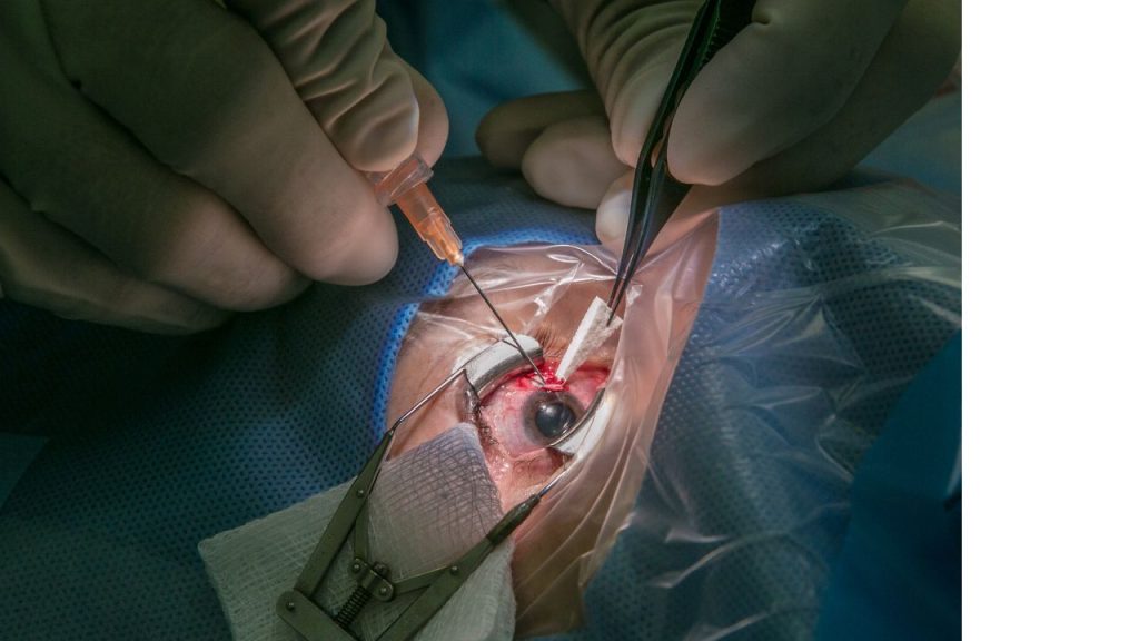 Monofocal IOL Surgery