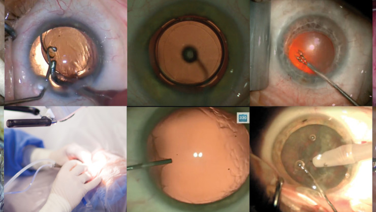 cataract surgery in Mumbai