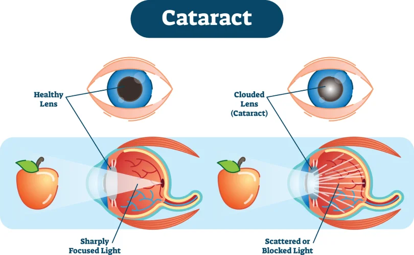 catact (1)