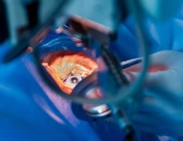 cataract-surgery