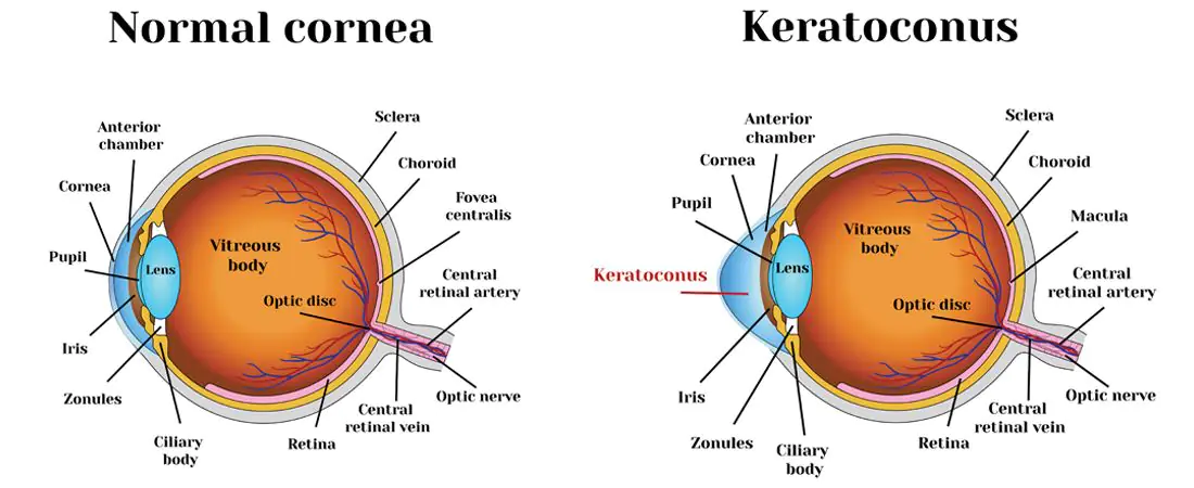 cornea-and-corneal-diseases