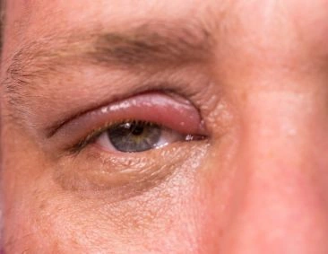eye-lid