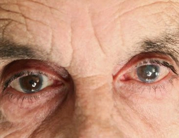 glaucoma-fron