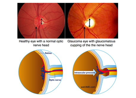 glaucoma