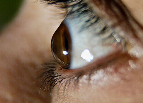 keratoconus