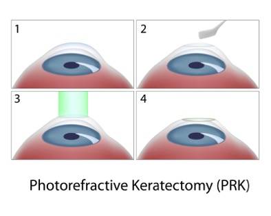 prk-photorefractive-keratectomy