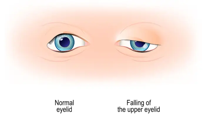 ptosis