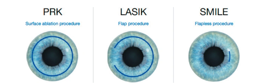 small-incision-lenticule-extraction